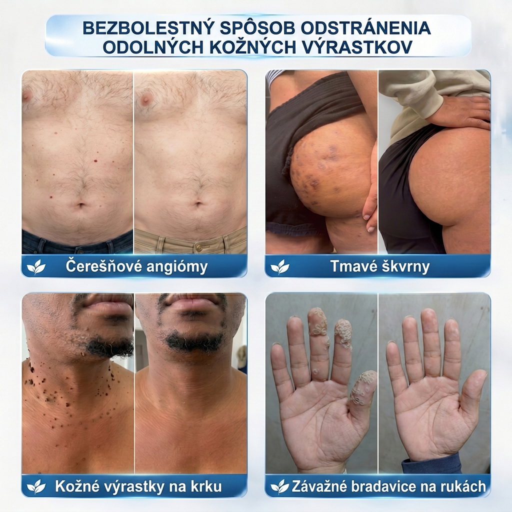 𝑶𝒇𝒊𝒄𝒊á𝒍𝒏𝒚 𝒐𝒃𝒄𝒉𝒐𝒅 👨‍⚕️🍀| 𝐇𝐈𝐒𝐊𝐈𝐍® 7-𝒅ň𝒐𝒗ý 𝒑𝒓í𝒑𝒓𝒂𝒗𝒐𝒌 𝒏𝒂 𝒐𝒅𝒔𝒕𝒓á𝒏𝒆𝒏𝒊𝒆 𝒌𝒐ž𝒏ý𝒄𝒉 𝒗ý𝒓𝒂𝒔𝒕𝒌𝒐𝒗 𝒂 𝒑𝒊𝒈𝒎𝒆𝒏𝒕𝒐𝒗ý𝒄𝒉 š𝒌𝒗ŕ𝒏👩‍⚕️ (𝒃𝒆𝒛 𝒃𝒐𝒍𝒆𝒔𝒕𝒊, 𝒃𝒆𝒛 𝒋𝒂𝒛𝒊𝒆𝒗, 𝒑𝒓𝒆𝒔𝒏ý 𝒓𝒐𝒍𝒍-𝒐𝒏 𝒂𝒑𝒍𝒊𝒌á𝒕𝒐𝒓) 🔥