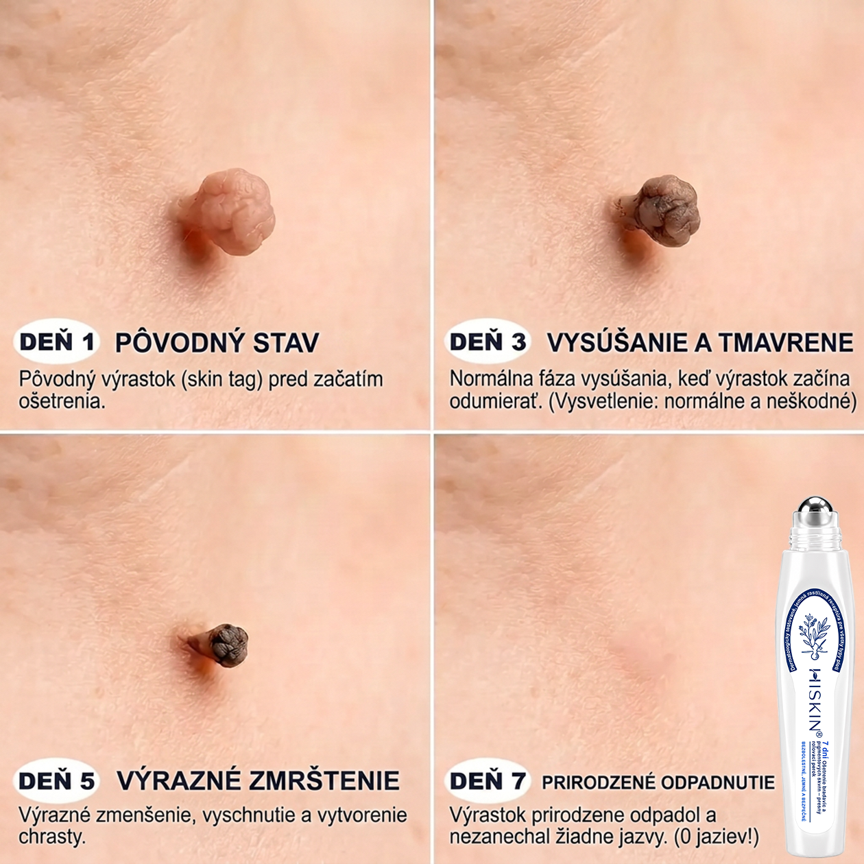 𝑶𝒇𝒊𝒄𝒊á𝒍𝒏𝒚 𝒐𝒃𝒄𝒉𝒐𝒅 👨‍⚕️🍀| 𝐇𝐈𝐒𝐊𝐈𝐍® 7-𝒅ň𝒐𝒗ý 𝒑𝒓í𝒑𝒓𝒂𝒗𝒐𝒌 𝒏𝒂 𝒐𝒅𝒔𝒕𝒓á𝒏𝒆𝒏𝒊𝒆 𝒌𝒐ž𝒏ý𝒄𝒉 𝒗ý𝒓𝒂𝒔𝒕𝒌𝒐𝒗 𝒂 𝒑𝒊𝒈𝒎𝒆𝒏𝒕𝒐𝒗ý𝒄𝒉 š𝒌𝒗ŕ𝒏👩‍⚕️ (𝒃𝒆𝒛 𝒃𝒐𝒍𝒆𝒔𝒕𝒊, 𝒃𝒆𝒛 𝒋𝒂𝒛𝒊𝒆𝒗, 𝒑𝒓𝒆𝒔𝒏ý 𝒓𝒐𝒍𝒍-𝒐𝒏 𝒂𝒑𝒍𝒊𝒌á𝒕𝒐𝒓) 🔥