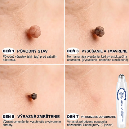 𝑶𝒇𝒊𝒄𝒊á𝒍𝒏𝒚 𝒐𝒃𝒄𝒉𝒐𝒅 👨‍⚕️🍀| 𝐇𝐈𝐒𝐊𝐈𝐍® 7-𝒅ň𝒐𝒗ý 𝒑𝒓í𝒑𝒓𝒂𝒗𝒐𝒌 𝒏𝒂 𝒐𝒅𝒔𝒕𝒓á𝒏𝒆𝒏𝒊𝒆 𝒌𝒐ž𝒏ý𝒄𝒉 𝒗ý𝒓𝒂𝒔𝒕𝒌𝒐𝒗 𝒂 𝒑𝒊𝒈𝒎𝒆𝒏𝒕𝒐𝒗ý𝒄𝒉 š𝒌𝒗ŕ𝒏👩‍⚕️ (𝒃𝒆𝒛 𝒃𝒐𝒍𝒆𝒔𝒕𝒊, 𝒃𝒆𝒛 𝒋𝒂𝒛𝒊𝒆𝒗, 𝒑𝒓𝒆𝒔𝒏ý 𝒓𝒐𝒍𝒍-𝒐𝒏 𝒂𝒑𝒍𝒊𝒌á𝒕𝒐𝒓) 🔥